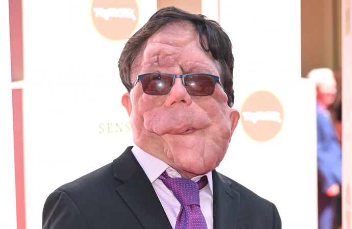Adam Pearson will star in The Elephant Man