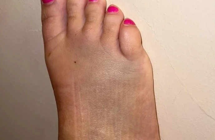 Kerry Katona has broken her foot (c) Instagram