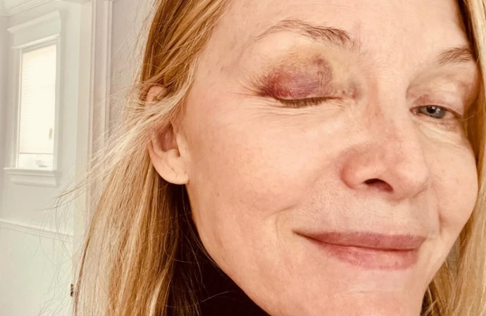 Michelle Pfeiffer got a black eye playing pickleball