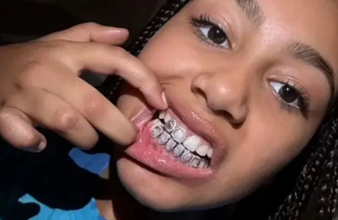 North West has flaunted a set of diamond teeth grills after her dad Kanye West showed off his metallic ‘dentures’