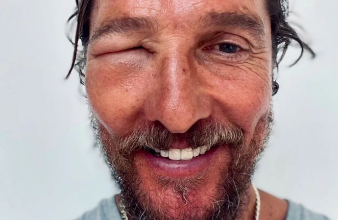 Matthew McConaughey has laughed off a severe reaction to a bee sting that left his face horrifically swollen