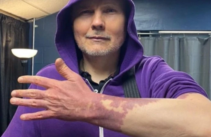 Billy Corgan has shown off his birthmark