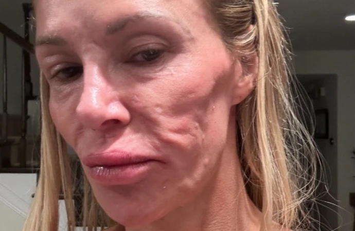 Brandi Glanville's facial disfigurement is impacting her love life