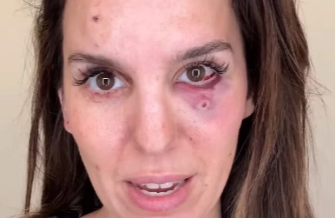 Christy Carlson Romano was 'shot in the eye' while taking her husband out for his birthday