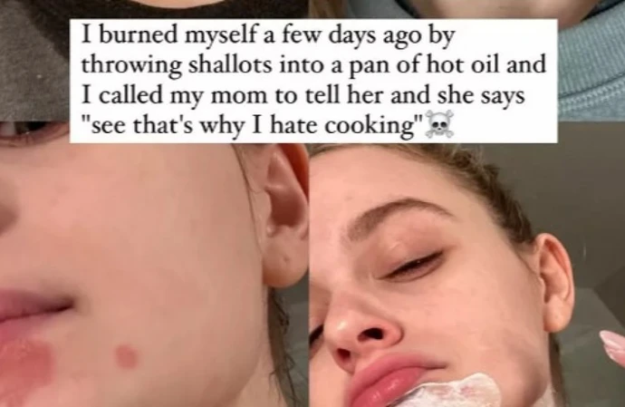 Joey King's chin is 'healing up nicely' after she suffered an accidental burn