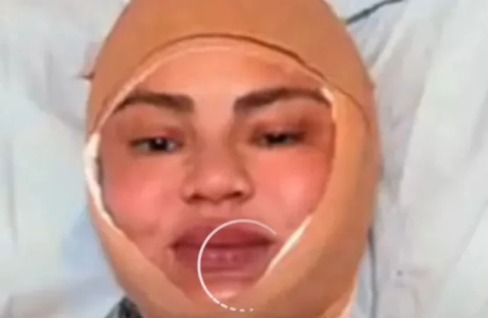 Chrissy Teigen has had her hairline lowered