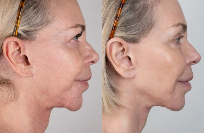 Leslie Ash's non-surgical facelift result / Credit: NeoGenPlasma.co.uk / Cavendish Press