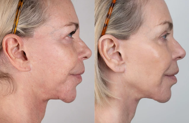 Leslie Ash's non-surgical facelift result / Credit: NeoGenPlasma.co.uk / Cavendish Press