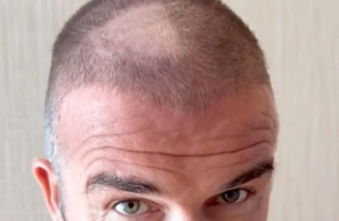 David Beckham has been left with a glaring bald spot after a DIY haircut went wrong
