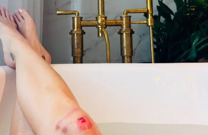 Katy Perry has revealed the bruises and scrapes she has sustained while performing on her Lifetimes tour