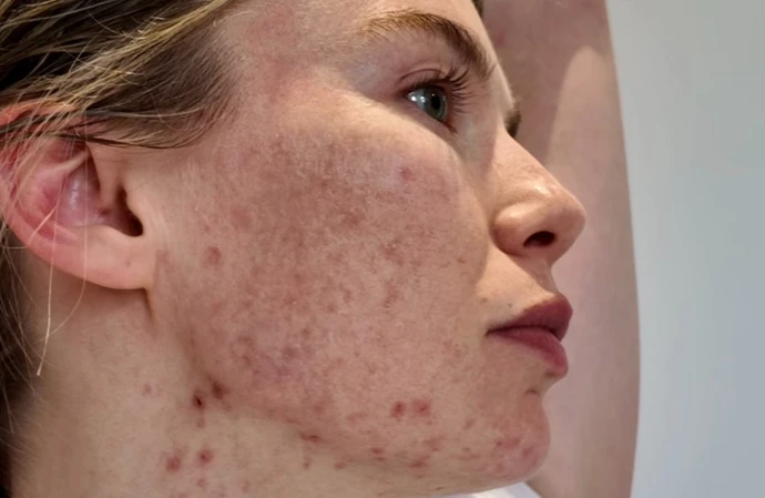 Georgia Toffolo shows off her acne / © Instagram