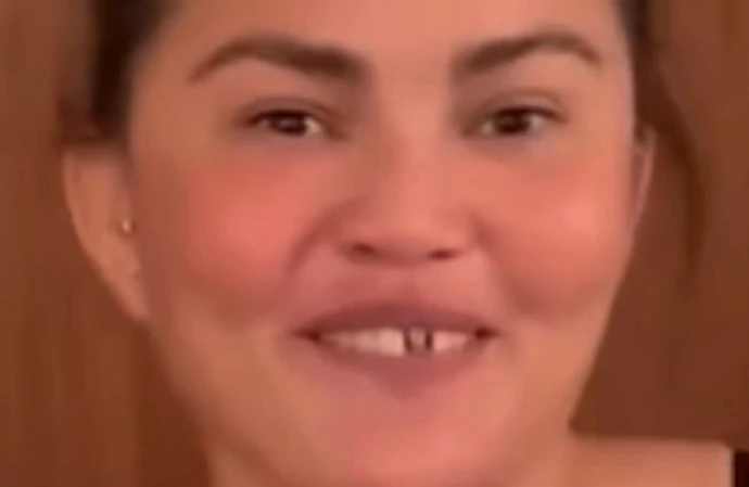 Chrissy Teigen missing her front veneer / © Instagram