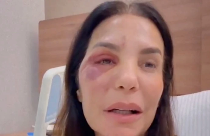 Ivete Sangalo sofreu uma queda em casa, que resultou na fratura de ossos da face