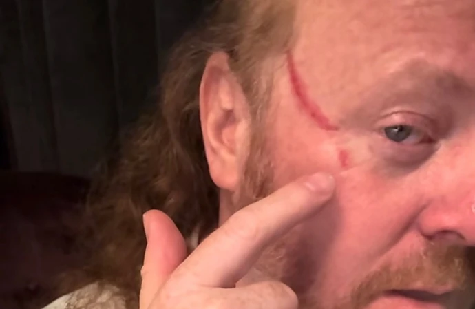 Comedian Leigh Francis shows off the red raw scratch on his face / © TikTok