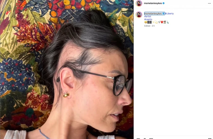 Melanie Sykes shows off her hair loss on either side of her head / © Instagram