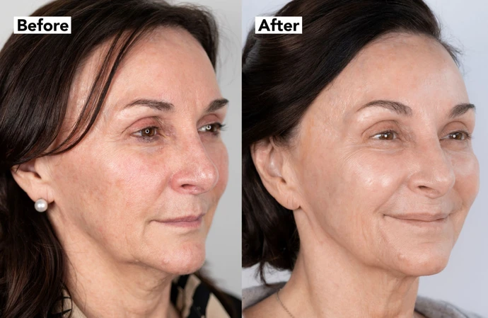 Shirley Ballas after her NeoGen nitrogen plasma sessions / Credit: NeoGenPlasma.co.uk / Cavendish Press