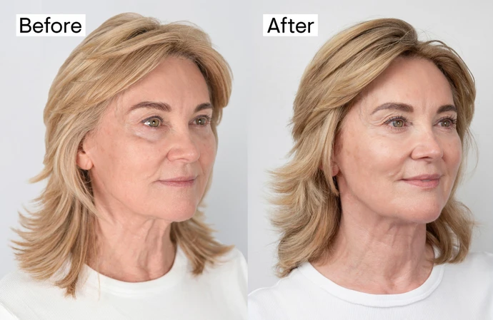 Shirley Ballas after her Focus Dual treatments / © lynton.co.uk
